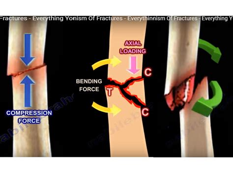 Four basic types of fracture mechanisms 